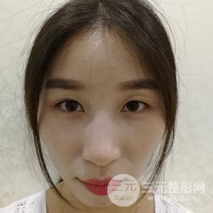 天津美高美辰医学美容门诊部全切双眼皮术前术后对比图