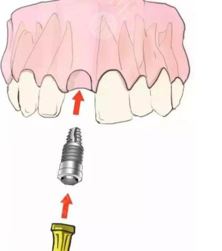种植牙的缺点