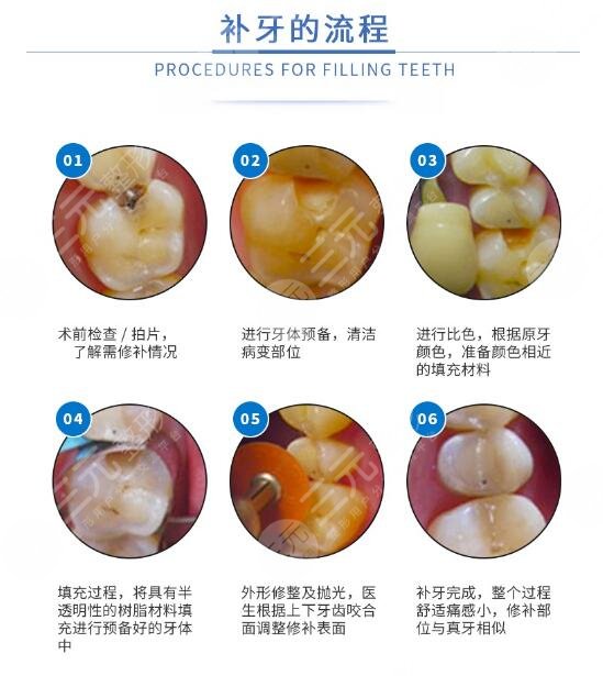 3m树脂补牙多少钱一颗