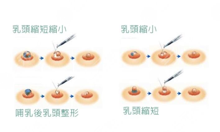 缩胸手术有风险吗?