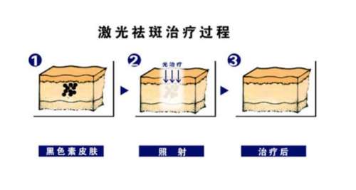 老年斑怎么去掉？推介6个土方法！网友都说好~