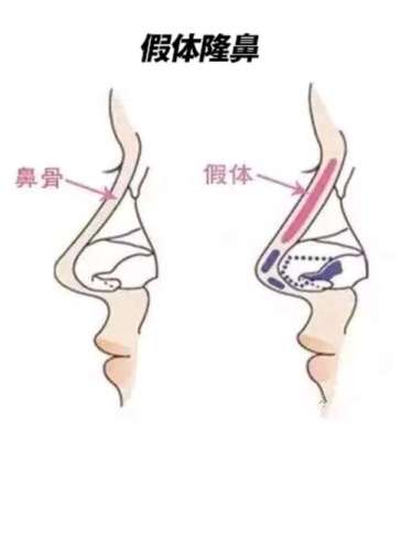 郑州王江允鼻子整形案例