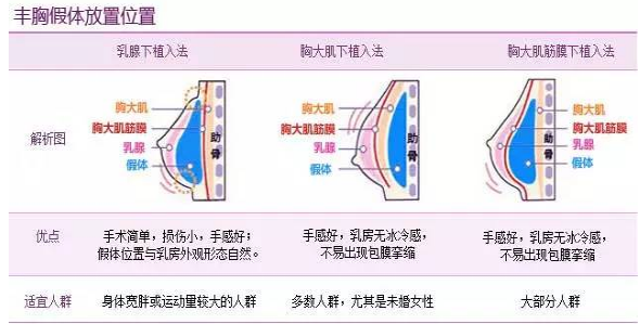 丰胸假体放置的位置