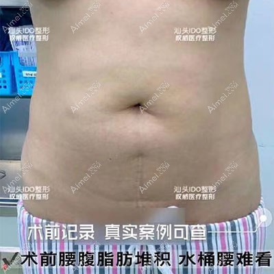 汕头爱都沪美人腰腹吸脂术前