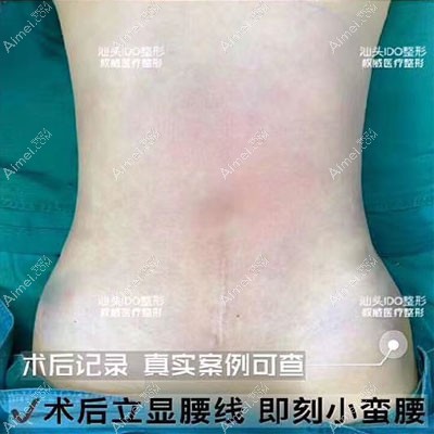 360水动力腰腹环吸术后效果图