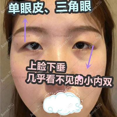 薛提朋做美杜莎眼综合效果惊艳,2个月眼睛大了一圈恢复自然