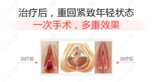 有做过3d生物束带紧缩术的分享吗?说下第五代具体费用贵不