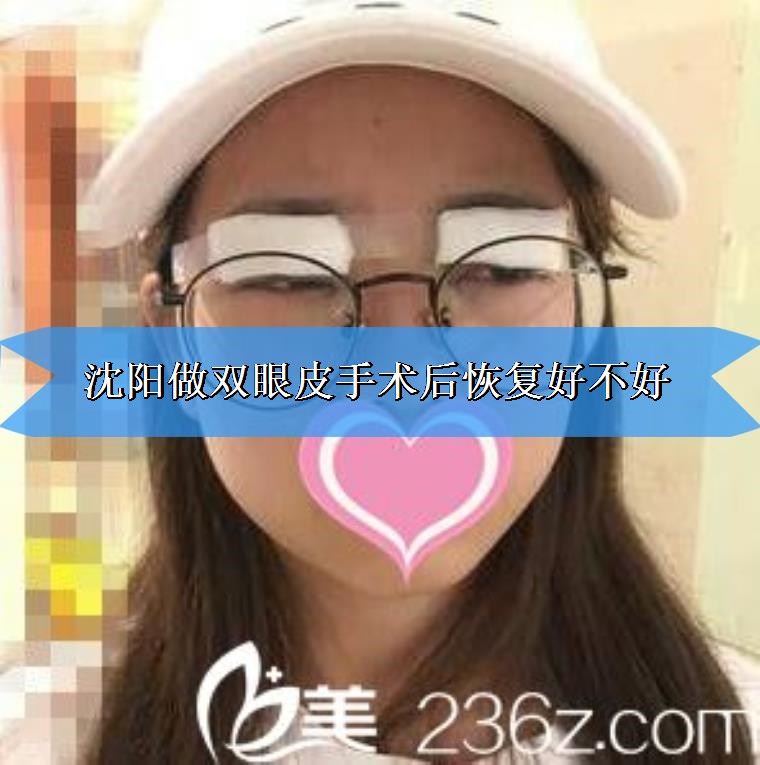 沈阳做双眼皮手术后恢复好不好