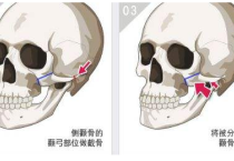 颧骨磨骨手术有后遗症吗?