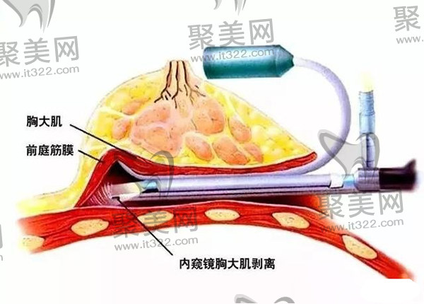 特贝茨隆乳术+内窥镜双平面隆胸技术