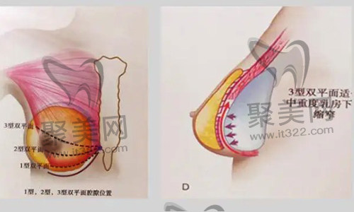 假体隆胸