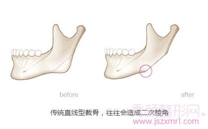 上海华美李志海磨骨怎么样？多少钱？