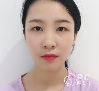 上海华美杨亚益割双眼皮开眼角恢复过程，7mm扇形真的很适合我！