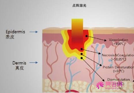 做彩光嫩肤好不好？这项技术可以治疗什么？做彩光嫩肤的注意事项