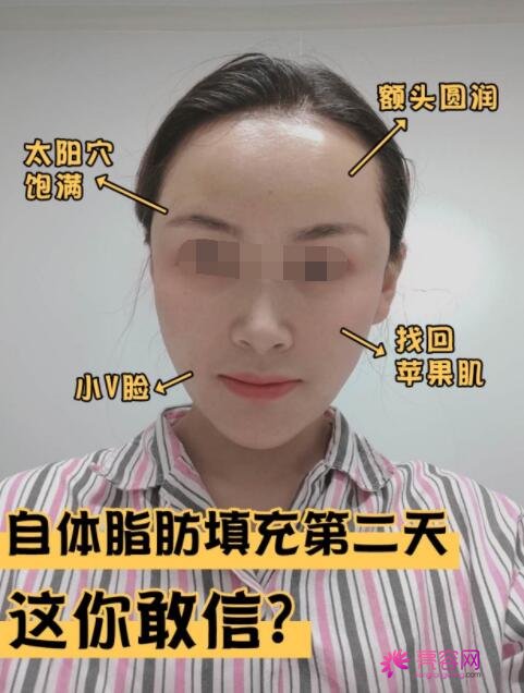 陈万芳脂肪填充果如何？来看个人简介以及真实手术案例，“幼幼脸”