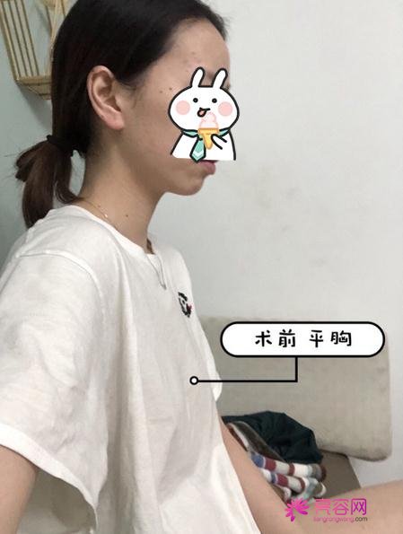 乳房整形前后对比，内附乳房整形术后恢复记录贴