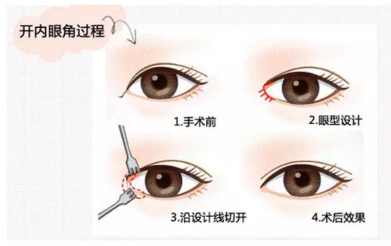 今日告诉您宁波开眼角价位