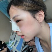 编辑来谈谈同样是隆鼻，为什么别人美翻天你却丑cry