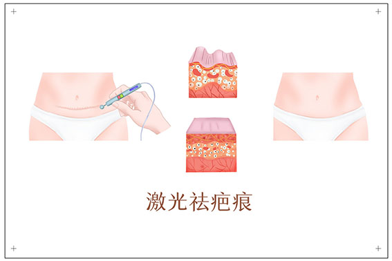 摄图网_401790821_banner_激光祛疤痕医美插画（非企业商用）.jpg