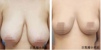 宜昌巨乳缩小手术多少钱