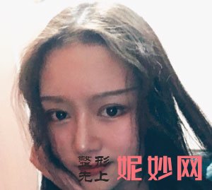 北京美莱医疗的叶宇做开内眼角案例分享，术后眼睛又大又有神！