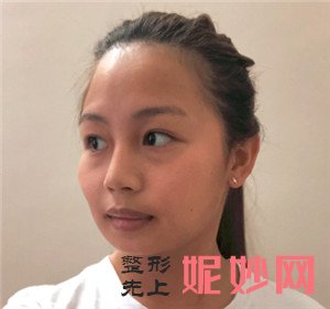 找北京京韩的乔爱军做的自体脂肪面部填充怎么样？术后脸部很饱满