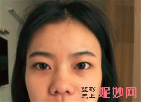 到北京百达丽找苏婷做的眼部多项的效果怎么样？真人案例对比图展示