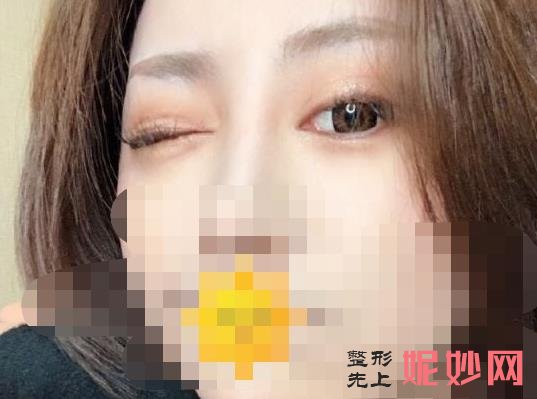 上海首尔丽格医疗美容医院怎么样？医院介绍，副双眼皮修复案例及价格表！