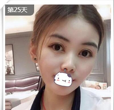 合肥蜜雪尔(德尔美客)正不正规?整形靠谱没失败附效果图及价格