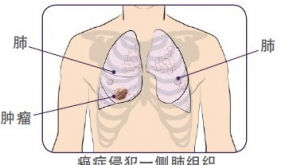 肺癌的手术治疗