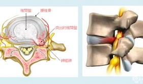 腰椎间盘突出症康复治疗