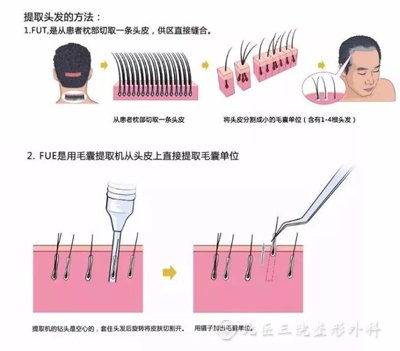 毛发移植技术