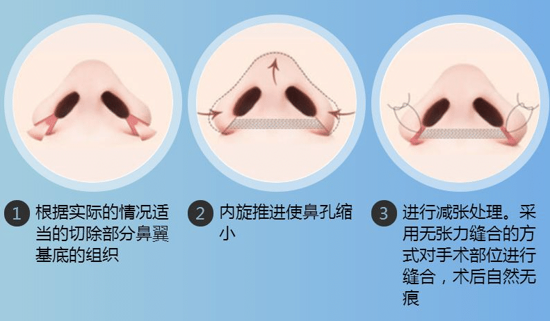 鼻翼缩小术留疤几率大吗?鼻孔整形效内切和外切哪个好?